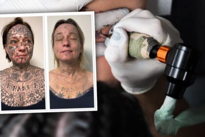 tattoo removal laser